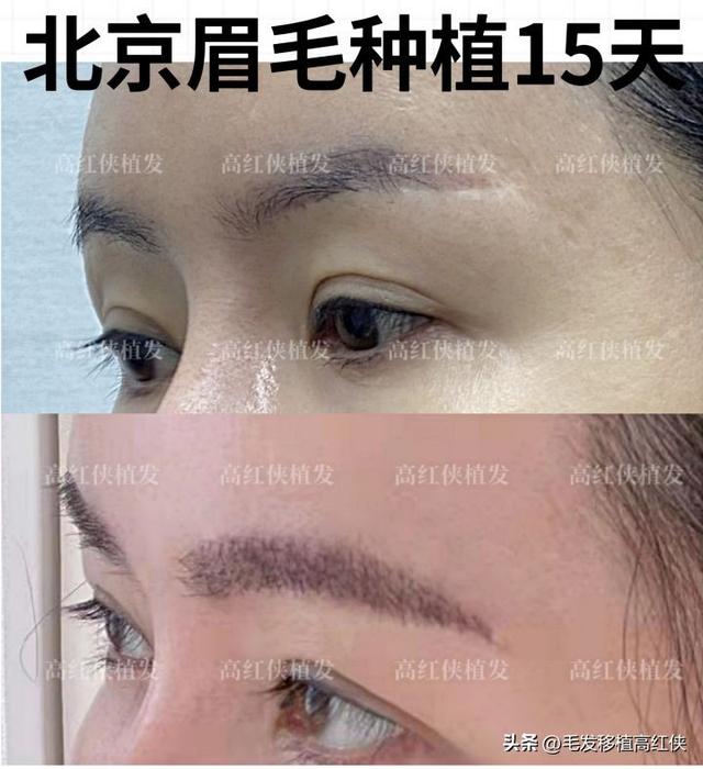 北京眉毛种植术后15天是什么效果