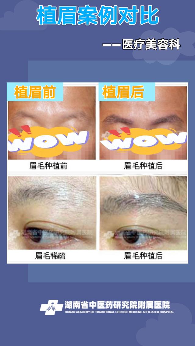 种植的眉毛是永久的吗？「湖南省中医药研究院附属医院」