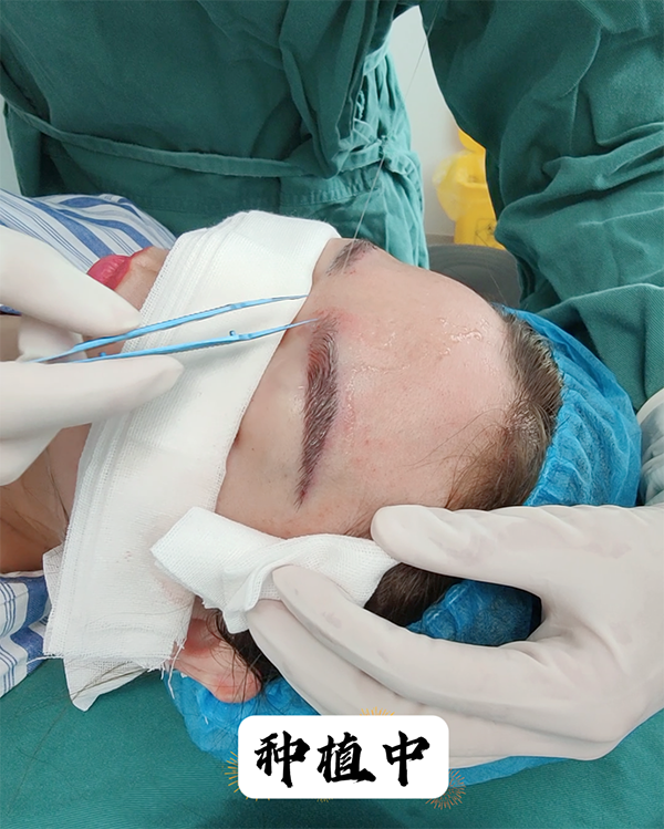 曲靖市二院毛发门诊成功开展多例自体毛发移植术、眉毛种植术