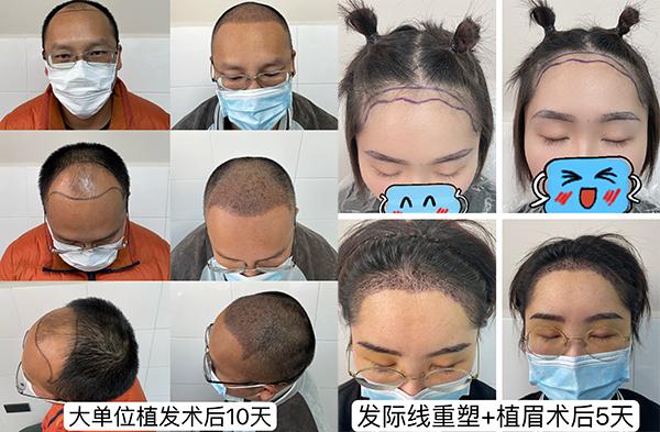 曲靖市二院毛发门诊成功开展多例自体毛发移植术、眉毛种植术