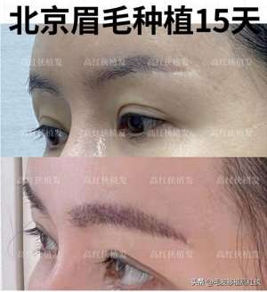 种植眉毛图(北京眉毛种植术后15天是什么效果)