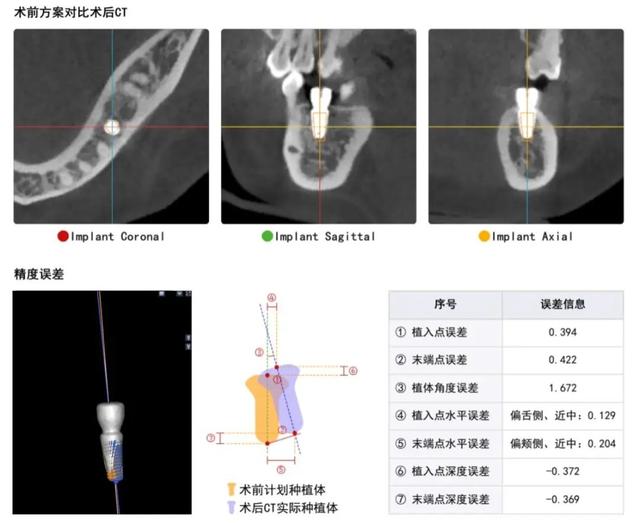 「新技术」南昌大学附属口腔医院完成首例数字化实时导航种植手术