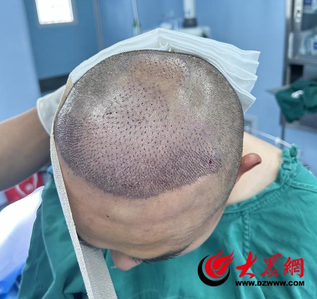 菏泽市中医医院开展首例FUE毛囊移植术 手术时间达7个多小时