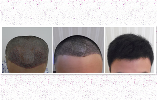 4种方法教你种植头发，永远远离秃顶的烦恼